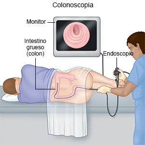 Procedimiento de Colonoscopia