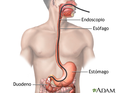 Esofagogastroduodenosendoscopia